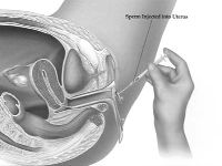 Potpomognuta oplodnja