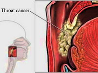 S oralnim seksom do raka na grlu